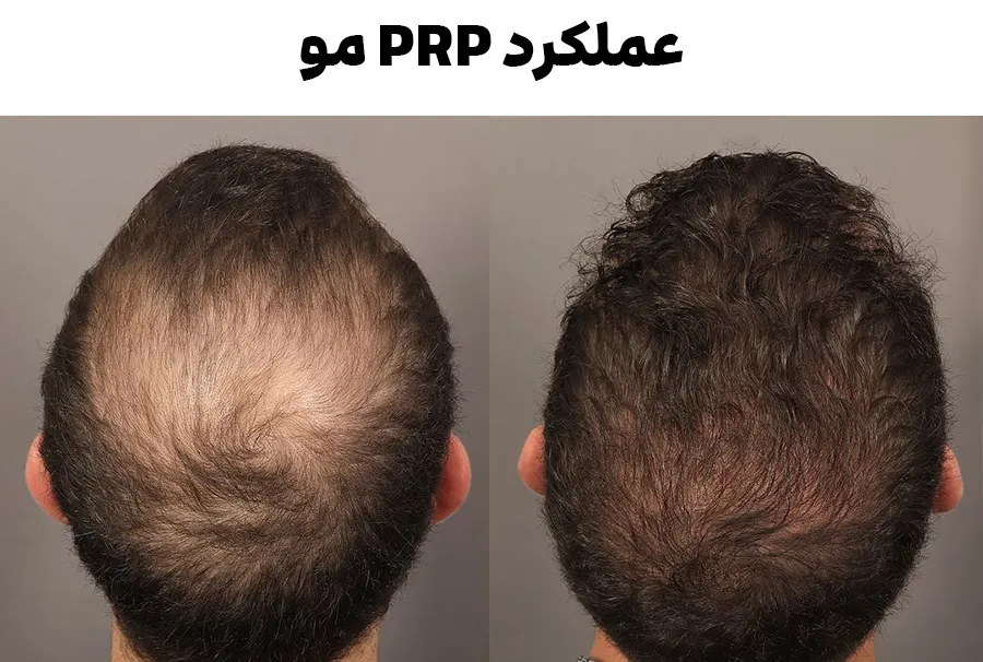 قبل و بعد PRP مو