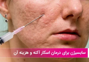 سابسیژن برای درمان اسکار آکنه و هزینه آن